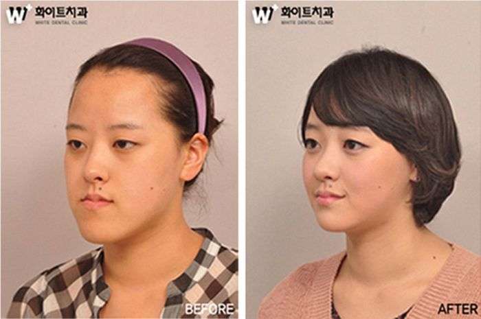 Пластична хірургія в стилі до і після (31 фото)