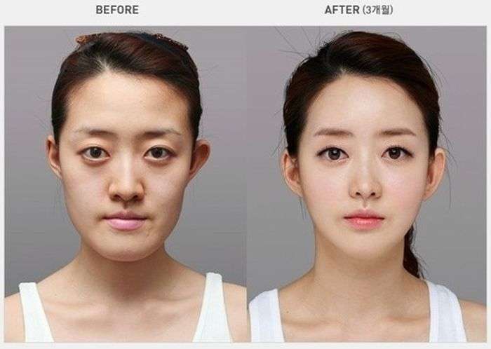 Пластична хірургія в стилі до і після (31 фото)